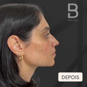 ANTES-E-DEPOIS-FULL-FACE-BRUNA-BIOCLINIC-2-1.jpg