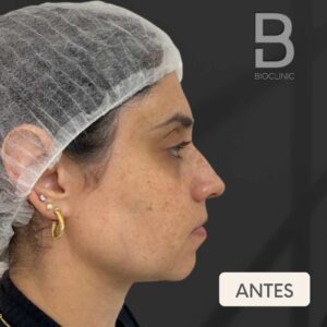 ANTES-E-DEPOIS-FULL-FACE-BRUNA-BIOCLINIC-2-2.jpg