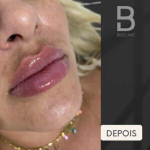 ANTES-E-DEPOIS-REJUVENESCIMENTO-LABIAL-BRUNA-BIOCLINIC-2-1.jpg