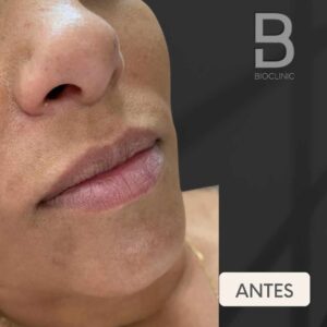 ANTES-E-DEPOIS-REJUVENESCIMENTO-LABIAL-BRUNA-BIOCLINIC-2.jpg