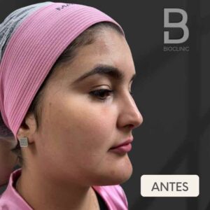 ANTES-FULL-FACE-BRUNA-BIOCLINIC.jpg