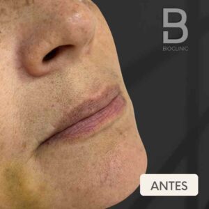 ANTES-REJUVENESCIMENTO-LABIAL-BRUNA-BIOCLINIC.jpg