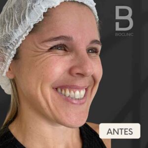 ANTES-TOXINA-FEMININA-OLHOS-BRUNA-BIOCLINIC.jpg