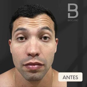 ANTES-TOXINA-MASCULINA-TESTA-BRUNA-BIOCLINIC.jpg