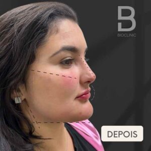 DEPOIS-FULL-FACE-BRUNA-BIOCLINIC.jpg