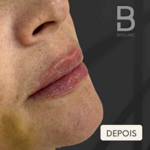 DEPOIS-REJUVENESCIMENTO-LABIAL-BRUNA-BIOCLINIC.jpg