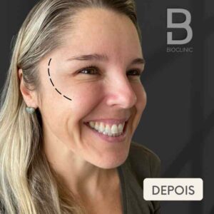 DEPOIS-TOXINA-FEMININA-OLHOS-BRUNA-BIOCLINIC.jpg