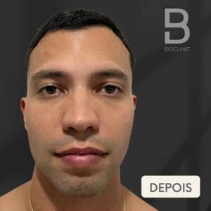 DEPOIS-TOXINA-MASCULINA-TESTA-BRUNA-BIOCLINIC.jpg